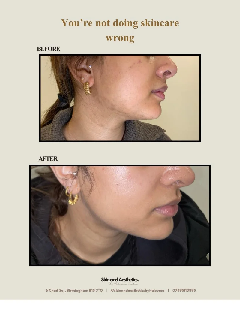 Skin treatment at Skin & Aesthetics By Haleema